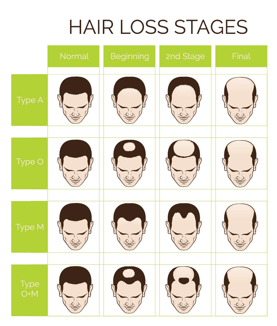 Hair Loss Stages